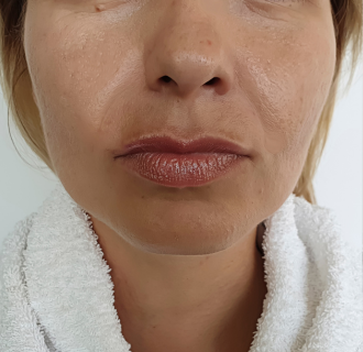 Before — Face Toner result