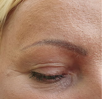 Before — Under Eye Roller result