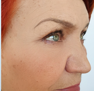 After — Retinol Night Serum result