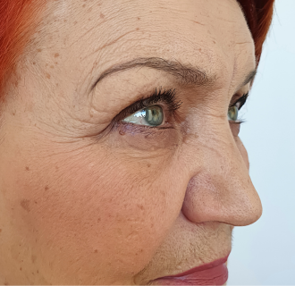 Before — Retinol Night Serum result